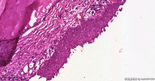 宫颈,HPV52(+),请教这些区域是CIN还是鳞化？图3