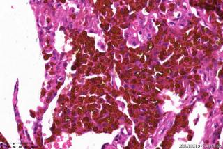 肺大疱周围组织，这些是含铁血黄素细胞吗？图10