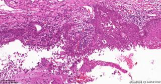 宫颈,HPV52(+),请教这些区域是CIN还是鳞化？图11