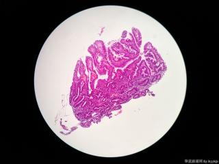 胃粘膜活检图12