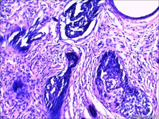 鼻根部肿块：基底细胞癌or毛发上皮瘤？图3