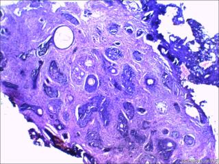 鼻根部肿块：基底细胞癌or毛发上皮瘤？图9