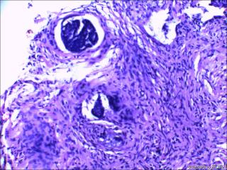 鼻根部肿块：基底细胞癌or毛发上皮瘤？图5