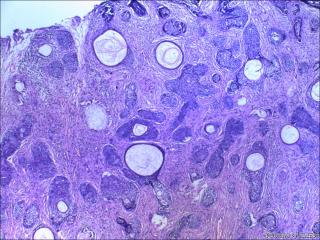 鼻根部肿块：基底细胞癌or毛发上皮瘤？图1