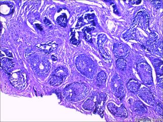 鼻根部肿块：基底细胞癌or毛发上皮瘤？图2