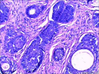 鼻根部肿块：基底细胞癌or毛发上皮瘤？图7