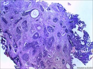 鼻根部肿块：基底细胞癌or毛发上皮瘤？图6