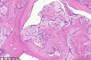 纤维腺瘤伴大汗腺化生？图6