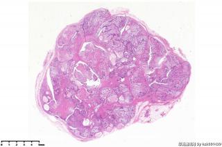 纤维腺瘤伴大汗腺化生？图1