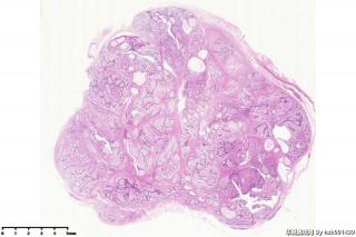 纤维腺瘤伴大汗腺化生？图10