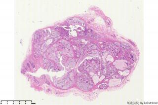 纤维腺瘤伴大汗腺化生？图13
