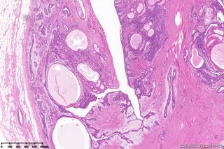 纤维腺瘤伴大汗腺化生？图2