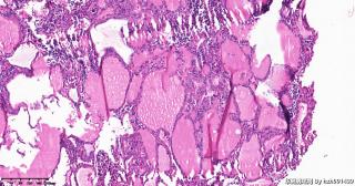 甲状腺包块图16