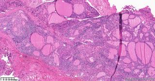 甲状腺包块图18