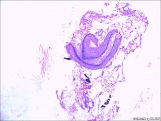 右中耳胆脂瘤内血管旁见红染宽大细胞是什么？图2