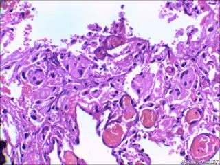 右中耳胆脂瘤内血管旁见红染宽大细胞是什么？图5