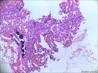 右中耳胆脂瘤内血管旁见红染宽大细胞是什么？图4