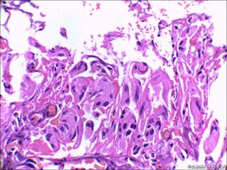 右中耳胆脂瘤内血管旁见红染宽大细胞是什么？图1