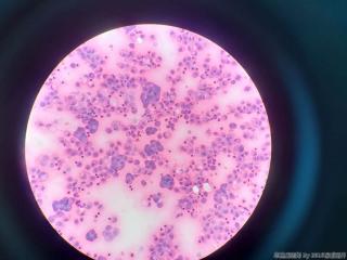 胸水，镜下大量团状增生的间皮细胞图11