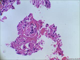 右中耳胆脂瘤内血管旁见红染宽大细胞是什么？图3