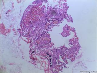 右中耳胆脂瘤内血管旁见红染宽大细胞是什么？图6
