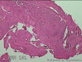 子宫肌瘤组织图21