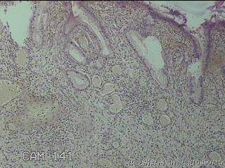 宫颈赘生物图14