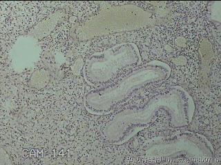 宫颈赘生物图15