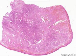 宫颈肌瘤，有那么多的血管正常吗？图6
