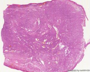 宫颈肌瘤，有那么多的血管正常吗？图1