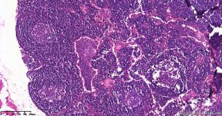 直肠腺癌围淋巴组织，这些是什么细胞？图2