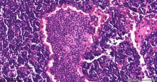 直肠腺癌围淋巴组织，这些是什么细胞？图5