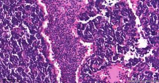 直肠腺癌围淋巴组织，这些是什么细胞？图4