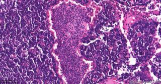 直肠腺癌围淋巴组织，这些是什么细胞？图3