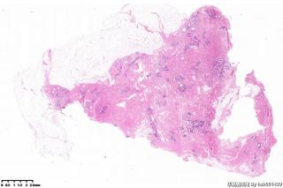 乳腺包块，纤维囊性乳腺病伴纤维腺瘤？图8