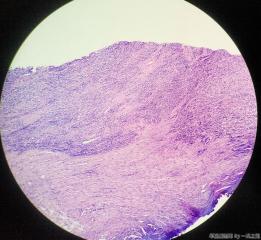 子宫粘膜下肌瘤图7