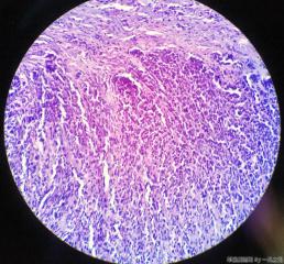子宫粘膜下肌瘤图18
