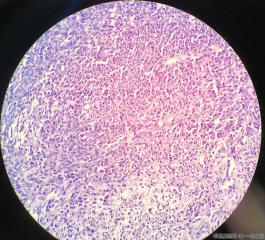 子宫粘膜下肌瘤图25