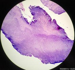 子宫粘膜下肌瘤图16
