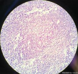 子宫粘膜下肌瘤图23