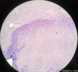 子宫粘膜下肌瘤图12