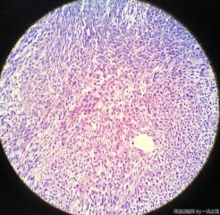 子宫粘膜下肌瘤图21
