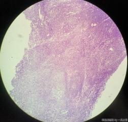 子宫粘膜下肌瘤图20
