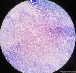 子宫粘膜下肌瘤图17