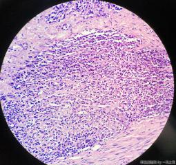 子宫粘膜下肌瘤图5