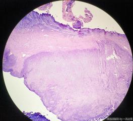 子宫粘膜下肌瘤图11