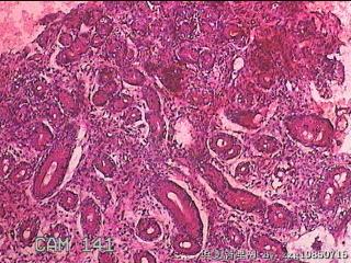 胃窦粘膜图17