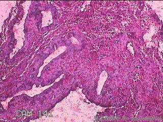 子宫腔内膜样组织图22