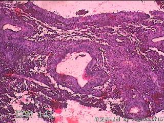 子宫腔内膜样组织图14