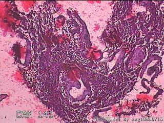 子宫腔内膜样组织图17